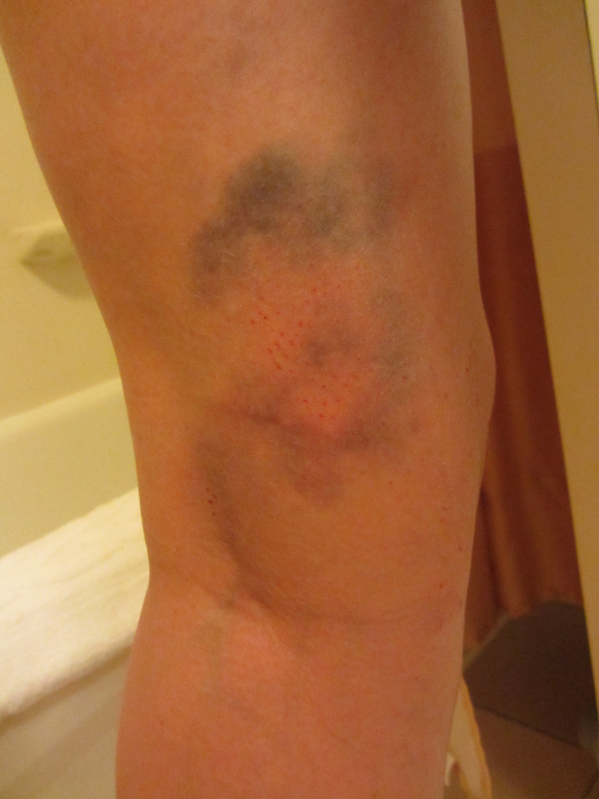 Barb Wire 4 Breakfast Bruises for Breakfast...a photo gallery