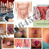 Mengobati Wasir Berdarah Yang Sering Kambuh thumbnail