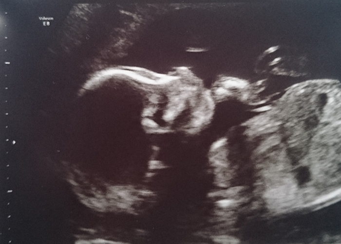 Pregnancy Update 19-22 weeks
