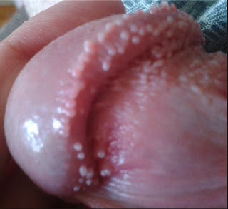 Obat Kutil Kelamin Penyakit Menular Seksual