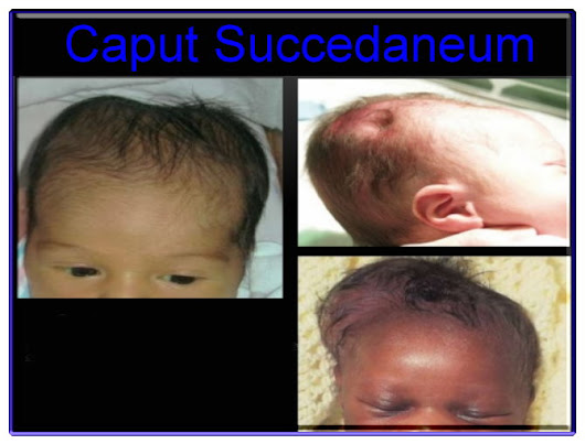 caput succedaneum