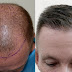 Why to Say Yes to Hair Transplants?