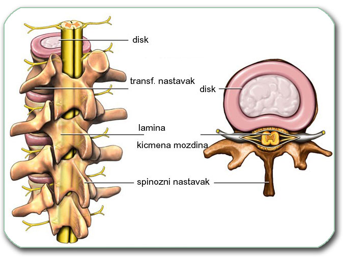 DISKUS HERNIJA Diskus hernija