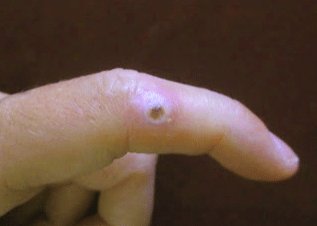 Hpv in finger, hhh | Cervical Cancer | Oral Sex Hpv am finger, Hpv am finger