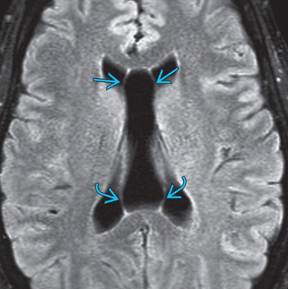 Cavum Septi Pellucidi (CSP) Brain imaging