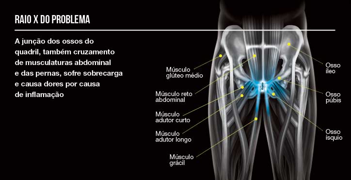 Goleiro Laércio Buranello: Lesão e tratamento da pubalgia.