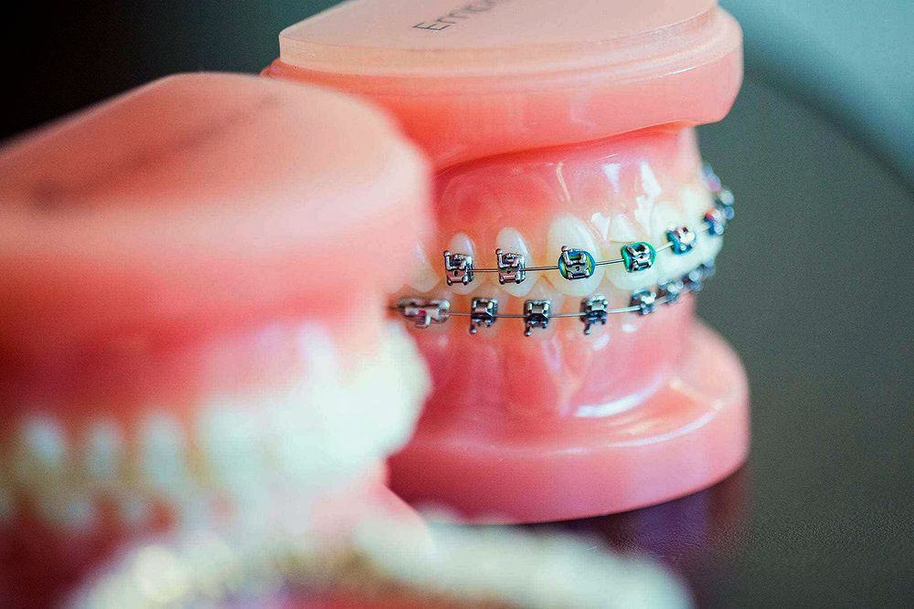 How Teeth Move / Braces Work ? Directorio Odontológico