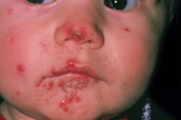 Eczema During Pregnancy >> Pediatrics Notes: October 2017 Eczema During Pregnancy >> Pediatrics Notes: October 2017