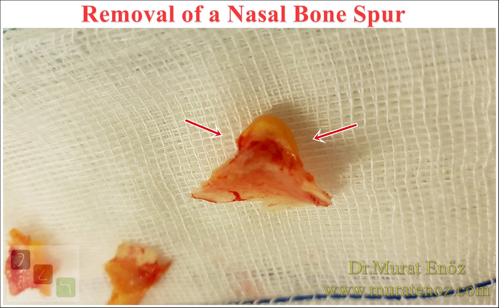 Nasal Bone Spur Removal Can Reduce The Your Headache!