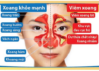 Điều trị Viêm Xoang Điều trị Viêm Xoang