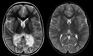 hasil pemeriksaaan kepala pasien Adrenoleukodystrophy 