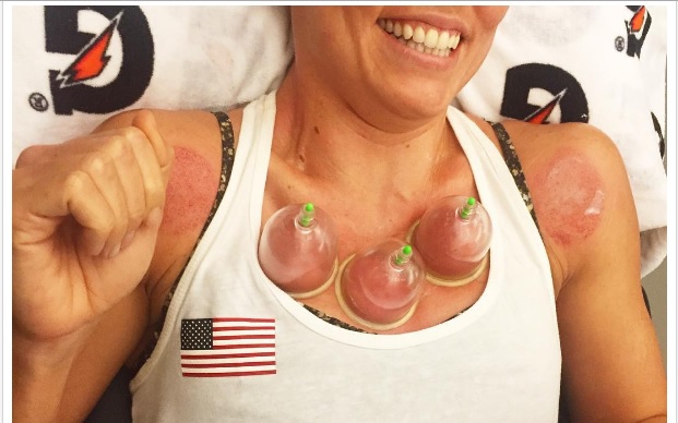 Team USA is Cupping Mideast Medical Tradition For Gold
