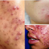 Treat Pimple Fast Using This 10 Best Simple Treatments You Can Do At Home!