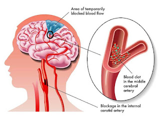 obat stroke hemoragik