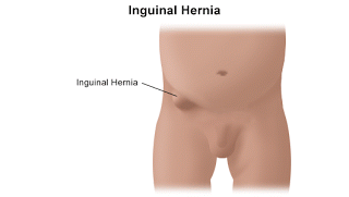 Obat Hernia Anak Alami Tanpa Operasi Obat Hernia Anak Alami Tanpa Operasi
