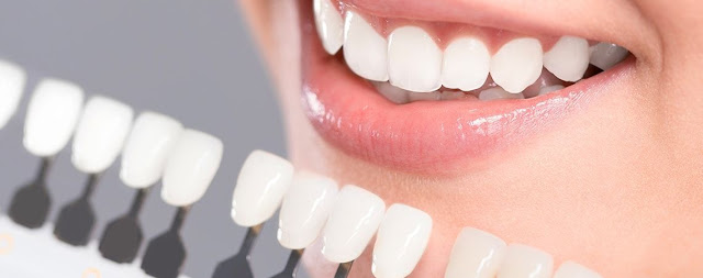 Como-blanquear-los-dientes