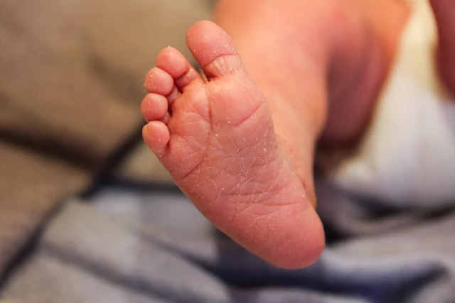 A dry and cracked newborn baby foot