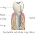 Biến chứng khi trồng răng implant không đúng cách