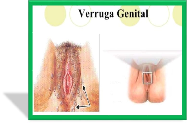 verrugas en el cuello uterino