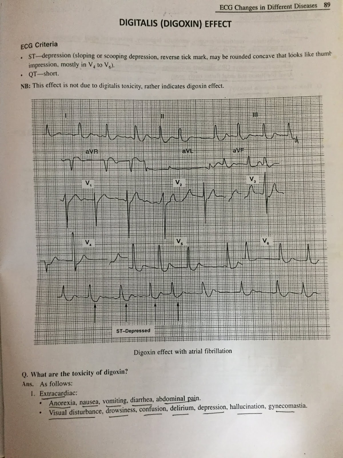 ECG DIGITALIS EFFECT ,HYPOKALEMIA AND HYPERKALEMIA