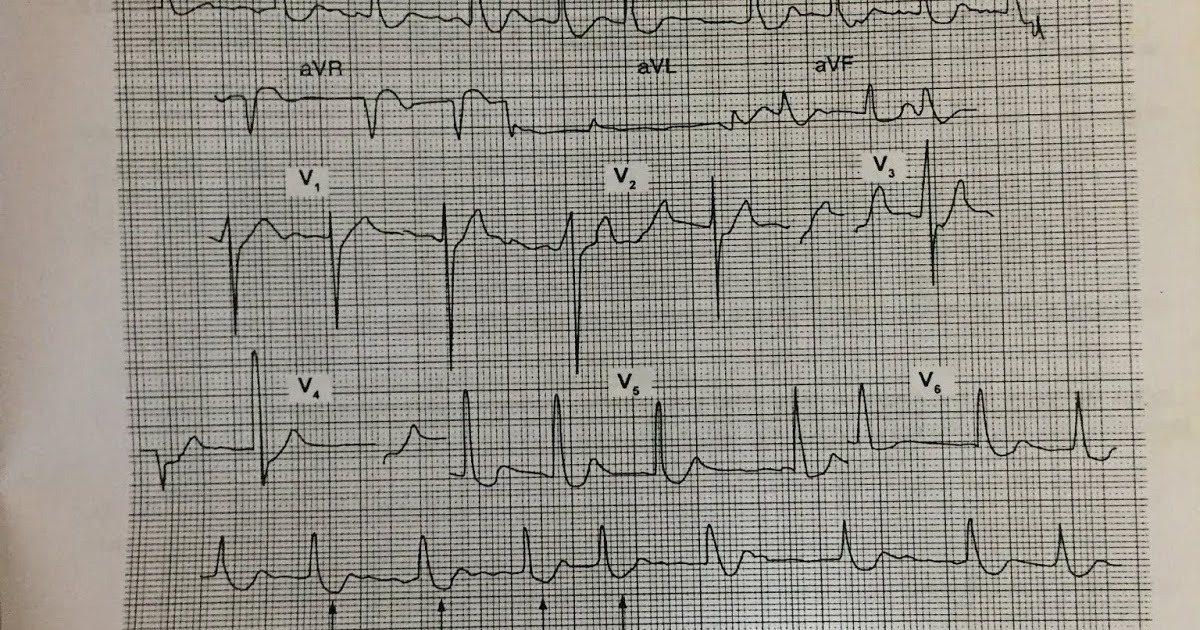 ECG DIGITALIS EFFECT ,HYPOKALEMIA AND HYPERKALEMIA