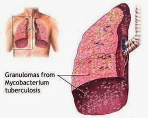 Miliary Tuberculosis