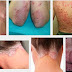 obat eksim yg paten thumbnail