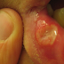 Stomatitis causes,types, diagnosis and treatment | Mouth diseases Stomatitis causes,types, diagnosis and treatment | Mouth diseases