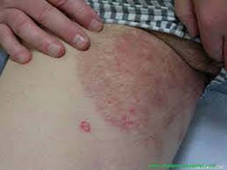 Obat Tradisional Gatal Selangkangan Pria