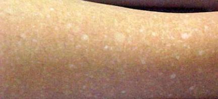 .: Quando a Pele se Mancha de Branco ...