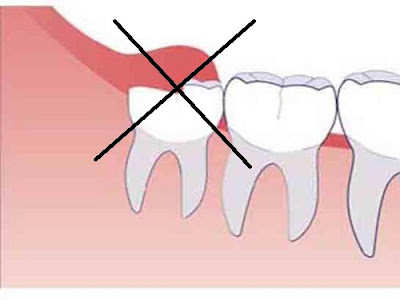 Niềng răng không cần nhổ răng ở đâu tốt?