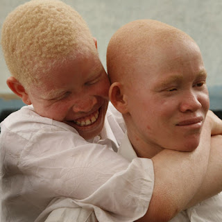 albino medical problems