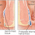This One Ingredient From Your Kitchen Will Cure Hemorrhoids in 24 Hours !