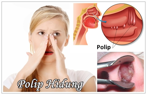 cara mengatasi penyakit polip hidung
