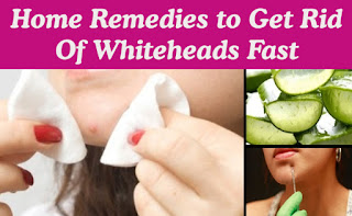 Home Remedies for Whiteheads in Hindi/Urdu. Home remedies for whiteheads in Hindi/Urdu. Whiteheads ke liye gharelu nuskhe.
