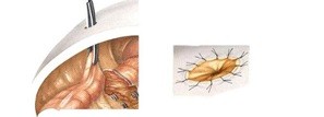 Teknik Operasi Colotomy Dan Colectomy pada Hewan (Bedah Sistma Digesti)