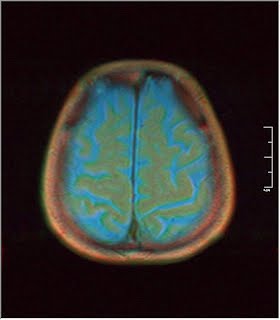 Nevit's blog: False-color Brain MRI (Motion artifacts)