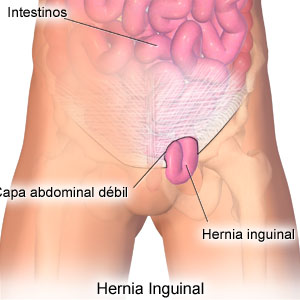 dolor de hernia en la ingle femenina dolor de hernia en la ingle femenina