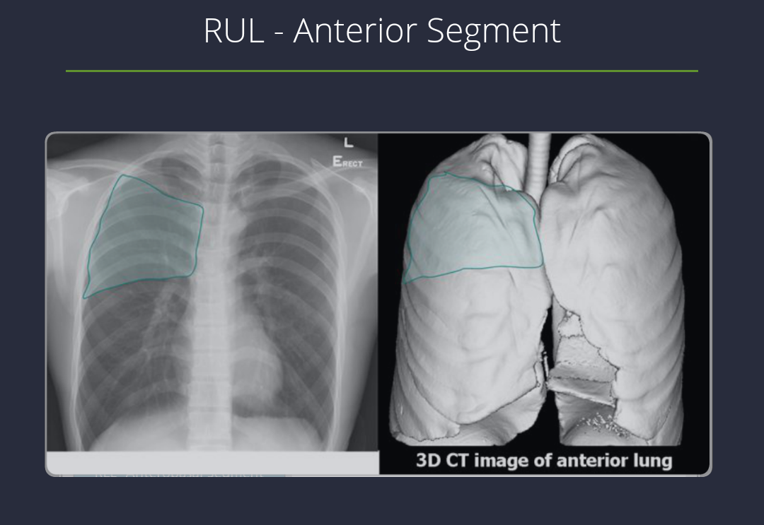 Medicowesome Chest Xray Right Lung!