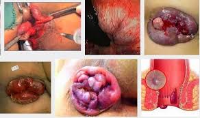 Foto Efek Samping Obat Wasir Ardium