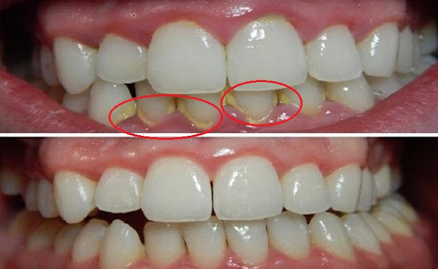 plaque remove dental naturally teeth dentist without accumulation procedures prevent needing definitive perform although solution development number