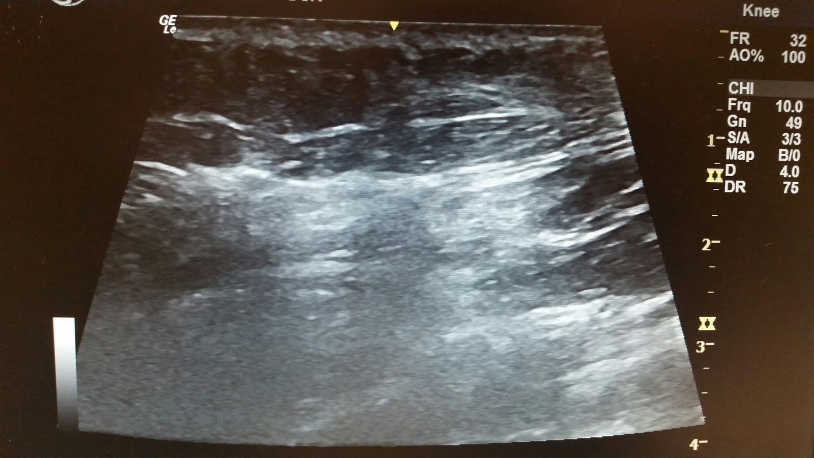 Fearless FAVA - Fibro Adipose Vascular Anomaly: Flare-ups, Emotions ...