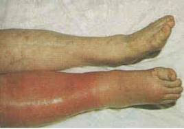 Superficial Phlebitis & Thrombophlebitis