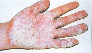 keratoderma blennorrhagica Pictures, Symptoms, Causes, Treatment keratoderma blennorrhagica Pictures, Symptoms, Causes, Treatment