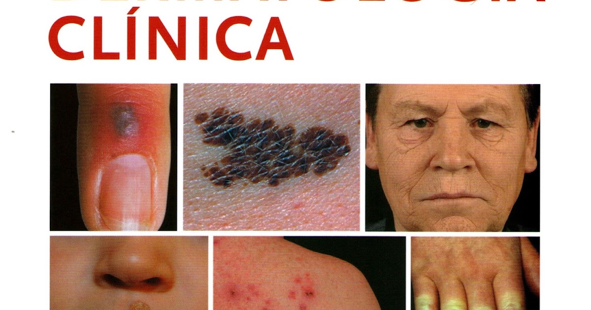LA BIBLIOTECA DEL DUME: ATLAS DE DERMATOLOGÍA CLÍNICA - FITZPATRICK 7MA ...