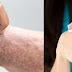 Eczema- Atopic Dermatitis: Allergies, Causes and Treatments