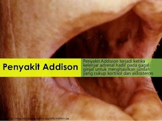 penyakit Addisons penyakit Addisons