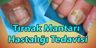 tırnak mantarı hastalığı tedavisi mantar tedavisi