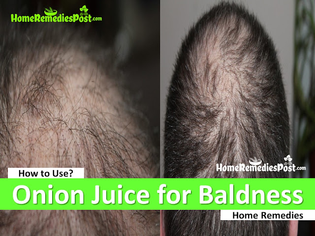 Onion Juice for Baldness, Fast Baldness Treatment, Home Remedies for Baldness, How To Get Rid Of Hair Loss, How To Get Rid Of Baldness, how to stop hair loss,