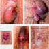 Obat Salep Wasir Berkualitas Ekspor thumbnail